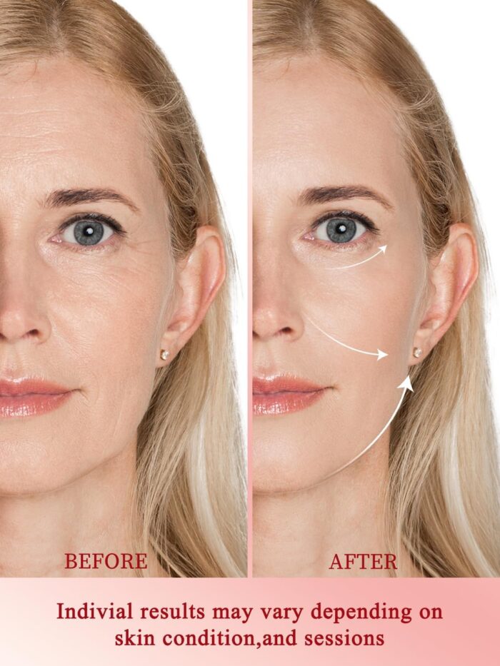 Radio Frequency Skin Tightening Device, Professional Wireless Home RF Skin Tightening Face Machine, Effective Face Wrinkle Removal, Lifting, Firming - Image 3