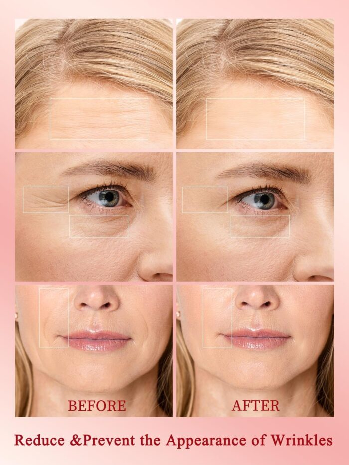 Radio Frequency Skin Tightening Device, Professional Wireless Home RF Skin Tightening Face Machine, Effective Face Wrinkle Removal, Lifting, Firming - Image 2