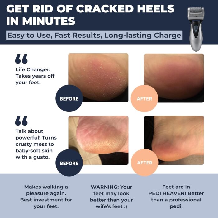 Electric Callus Remover for Feet: Best Pedicure Tools for Men by Own Harmony with 3 Rollers (Powerful), Electronic Pedi Spa Foot File Care - Perfect for Hard, Cracked, Dry, Dead Skin (USB Cable) - Image 2